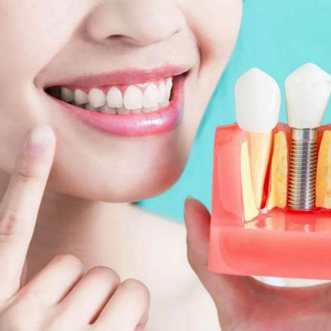 Какие поставить импланты зубов