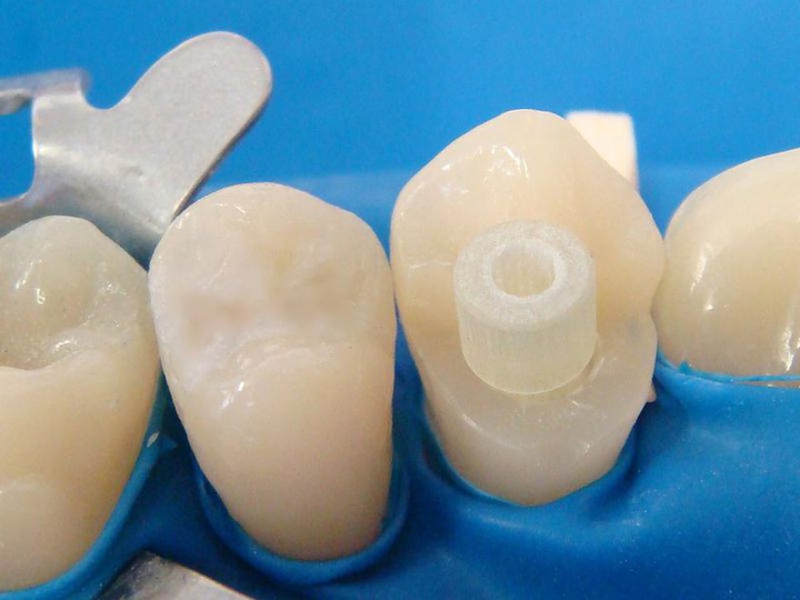 Микропротезирование: Как восстанавливают зубы стекловолокном