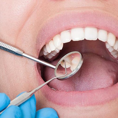 Ученые разработали антикариесное средство, способное предотвратить разрушение зубов